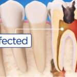 Root Canal in Summerville SC