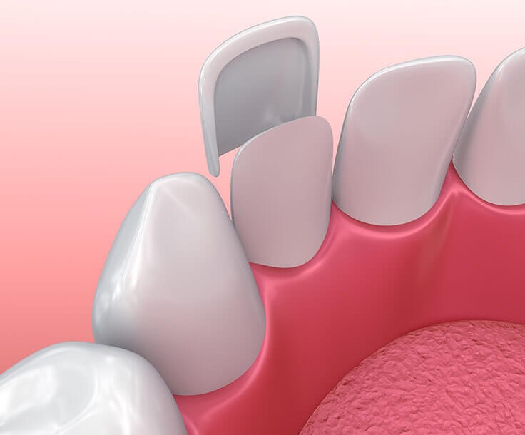 illustration of a porcelain veneer