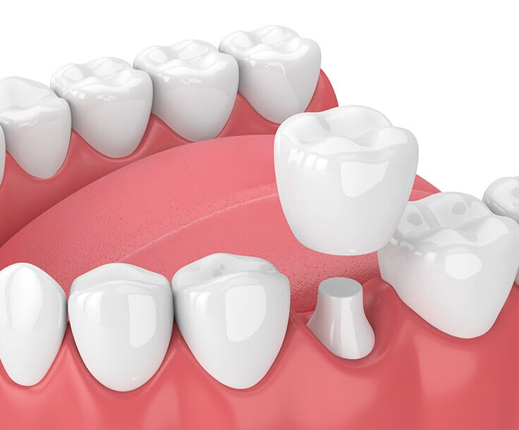 illustration of a dental crown