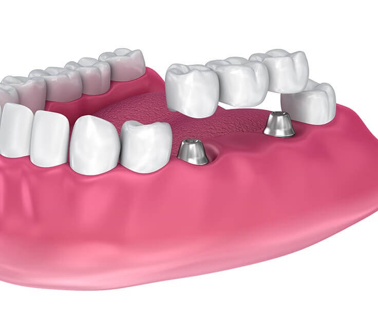 illustration of a dental bridge