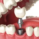dental implants in Summerville