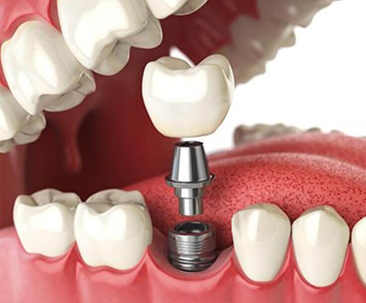 dental implants in Summerville