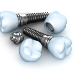 dental implant components