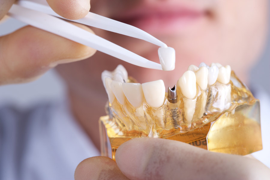 dentist uses a model to demonstrate dental implant process