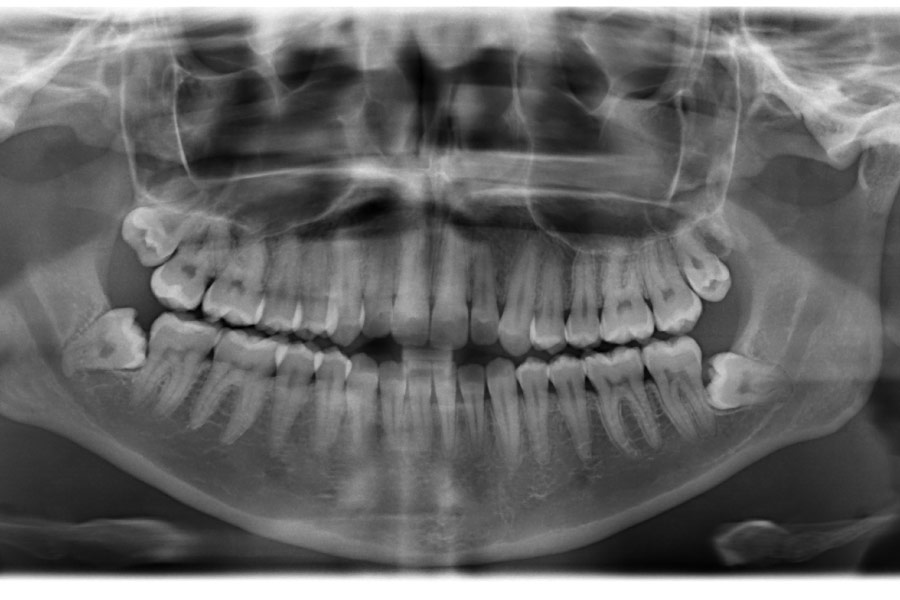 panoramic x-ray of the mouth