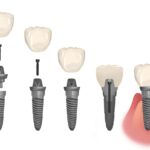 parts of a dental implant