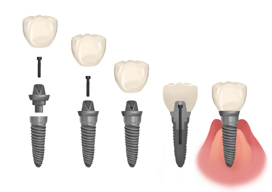 parts of a dental implant