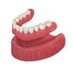 snap-in dentures on mini dental implants on mandible