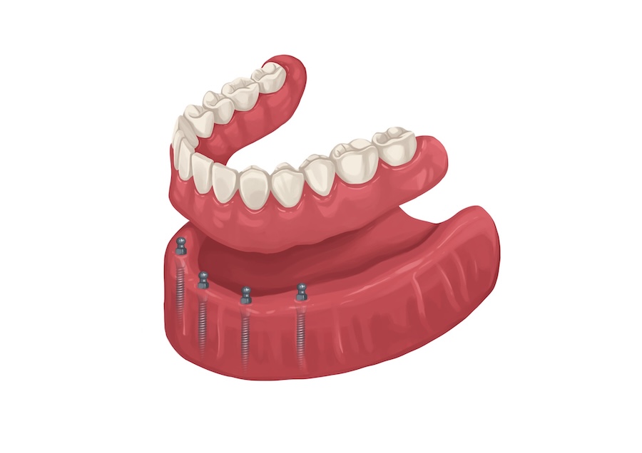 snap-in dentures on mini dental implants on mandible