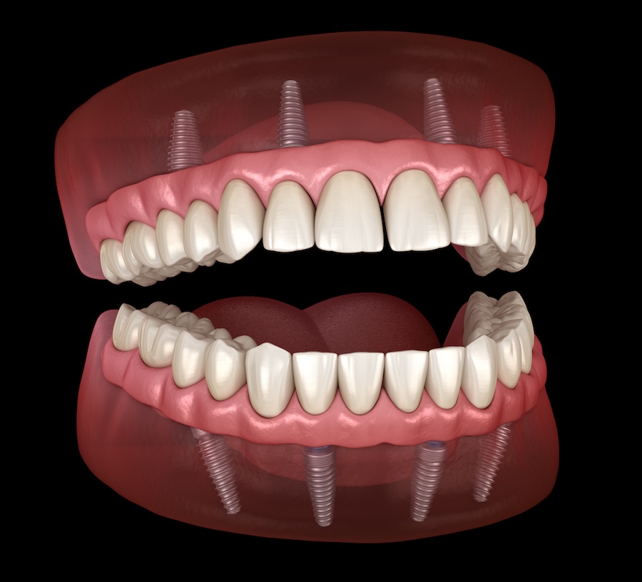 all-on-4 or all-on-x dentures a type of advanced dentures