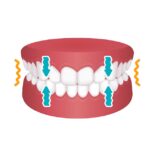 teeth grinding and clenching on a model of the jaw