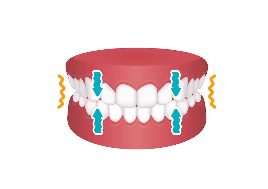 teeth grinding and clenching on a model of the jaw